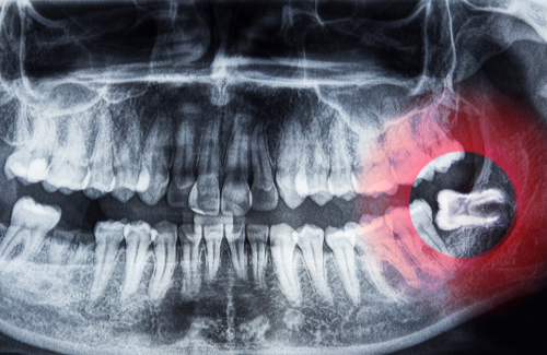 横向きに生えた親知らず