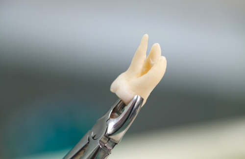 親知らずの抜歯