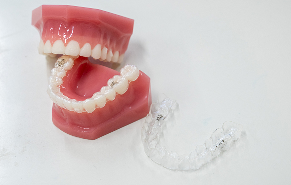 インビザライン