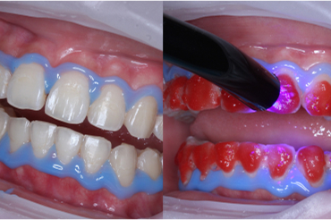 オフィスホワイトニング