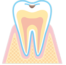 初期の虫歯