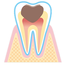 重度の虫歯