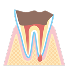 末期の虫歯