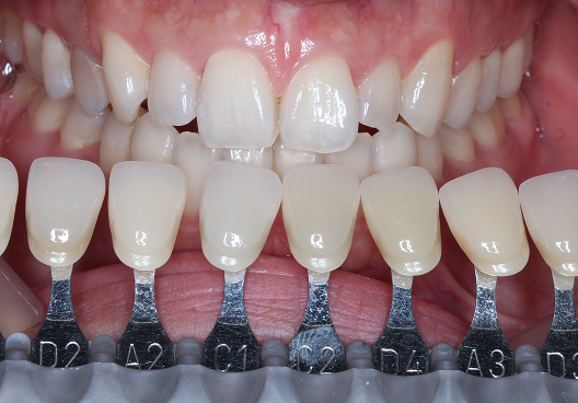 ホワイトニング