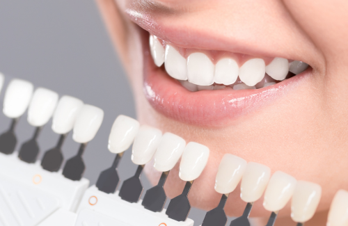 ホワイトニング